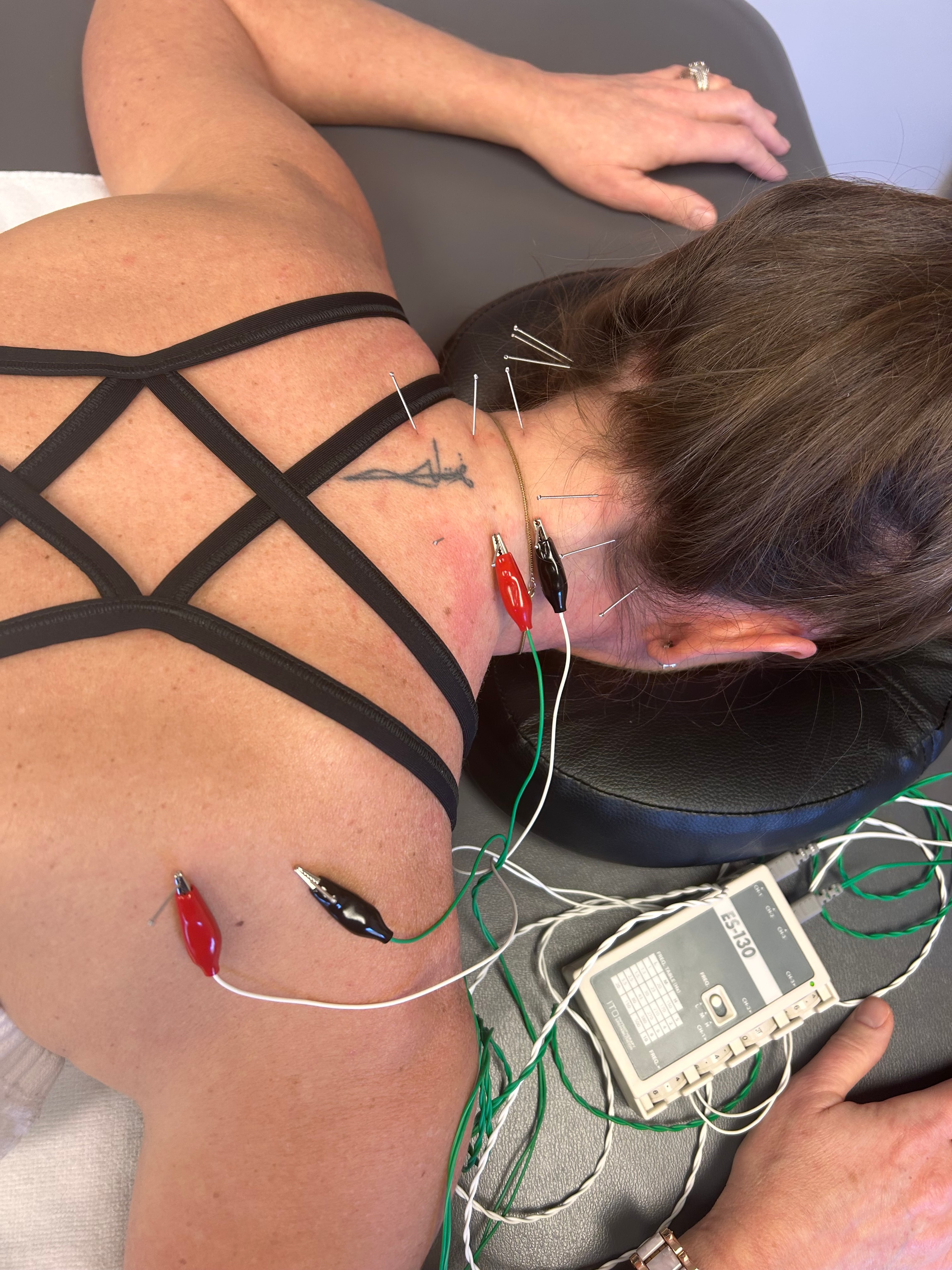 Brian Hortz, PhD, ATC/L performing dry needling treatment